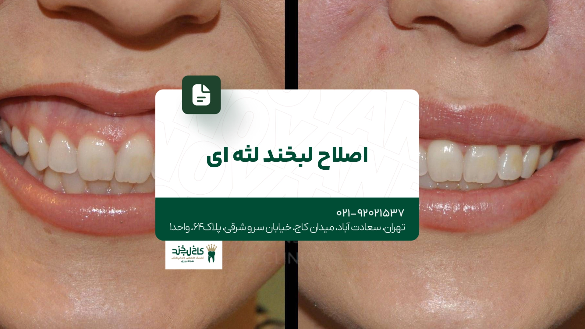 اصلاح لبخند لثهای