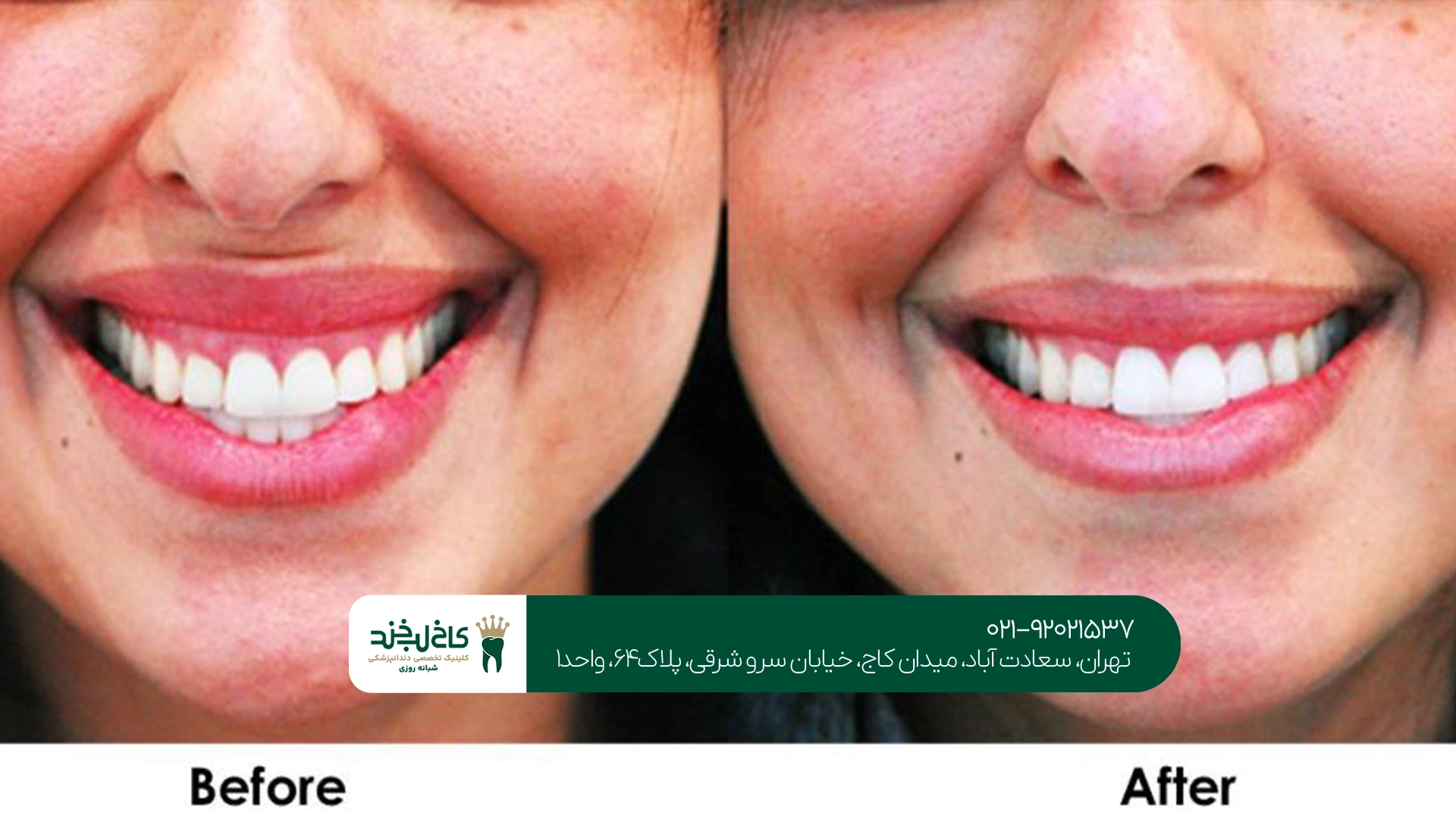 علت ایجاد لبخند لثهای چیست؟