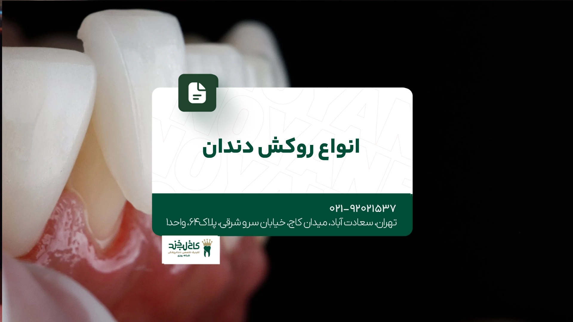 انواع روکش دندان انواع روکش دندان