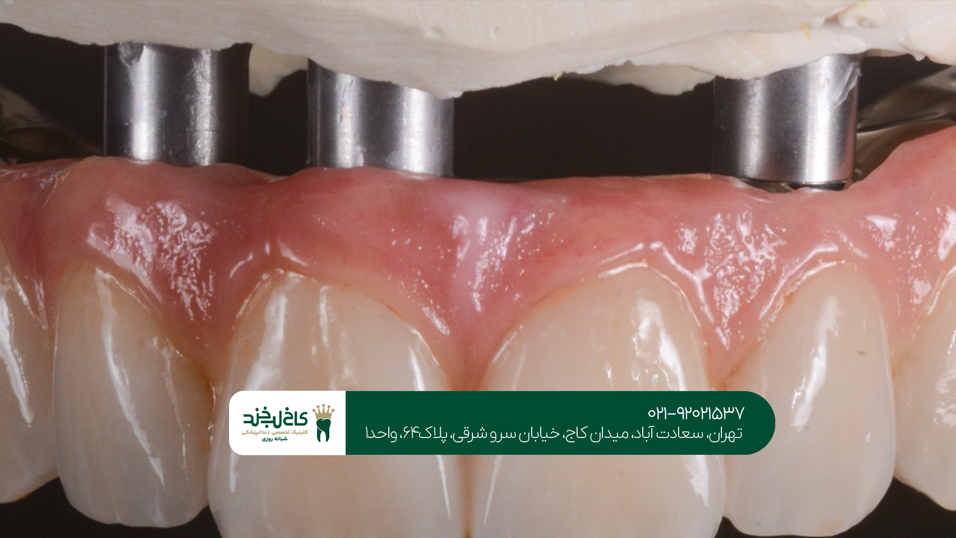 انواع اوردنچر و تفاوت آنها انواع اوردنچر و تفاوت آنها