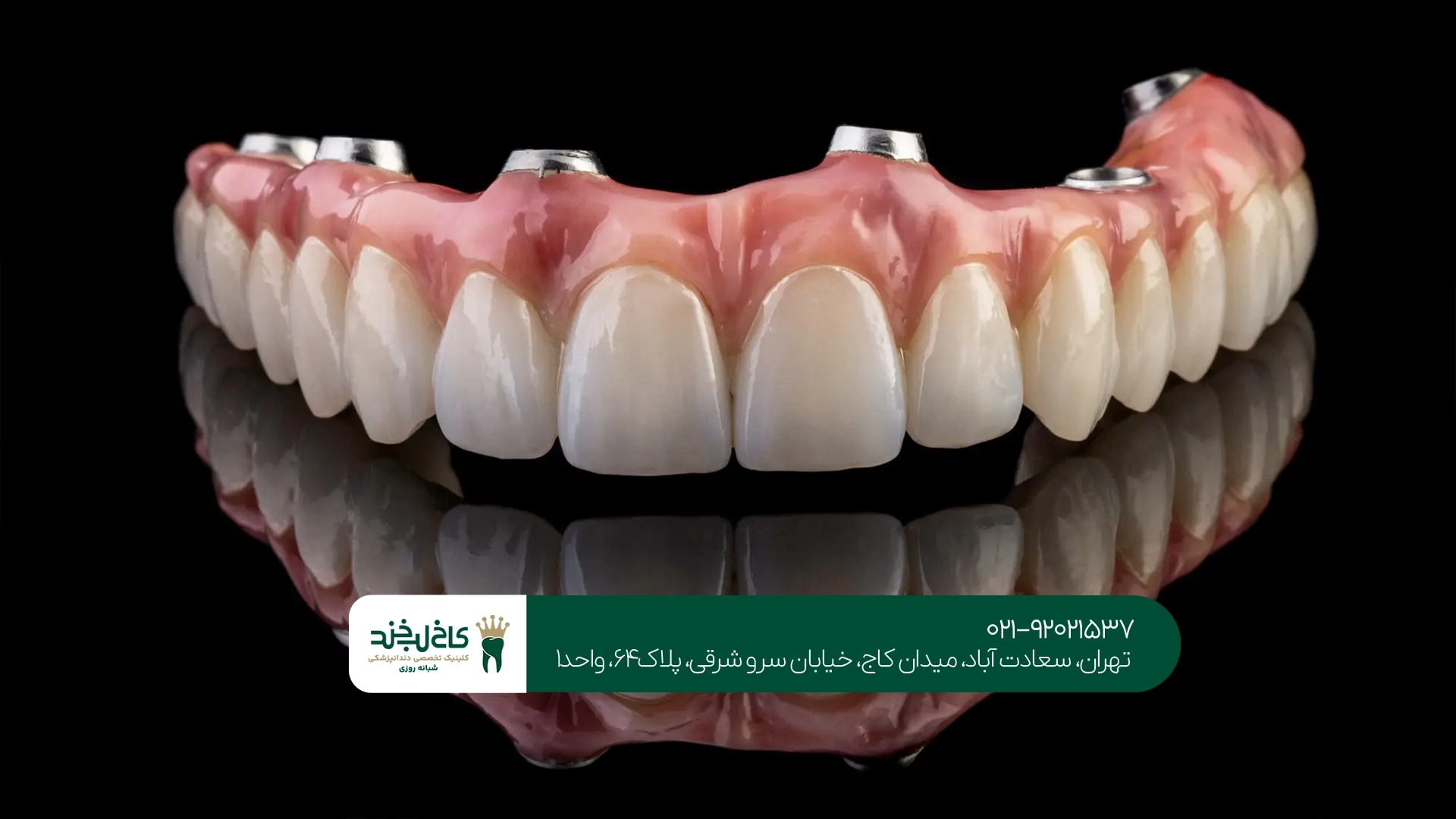 تفاوت اوردنچر با دندان مصنوعی معمولی تفاوت اوردنچر با دندان مصنوعی معمولی
