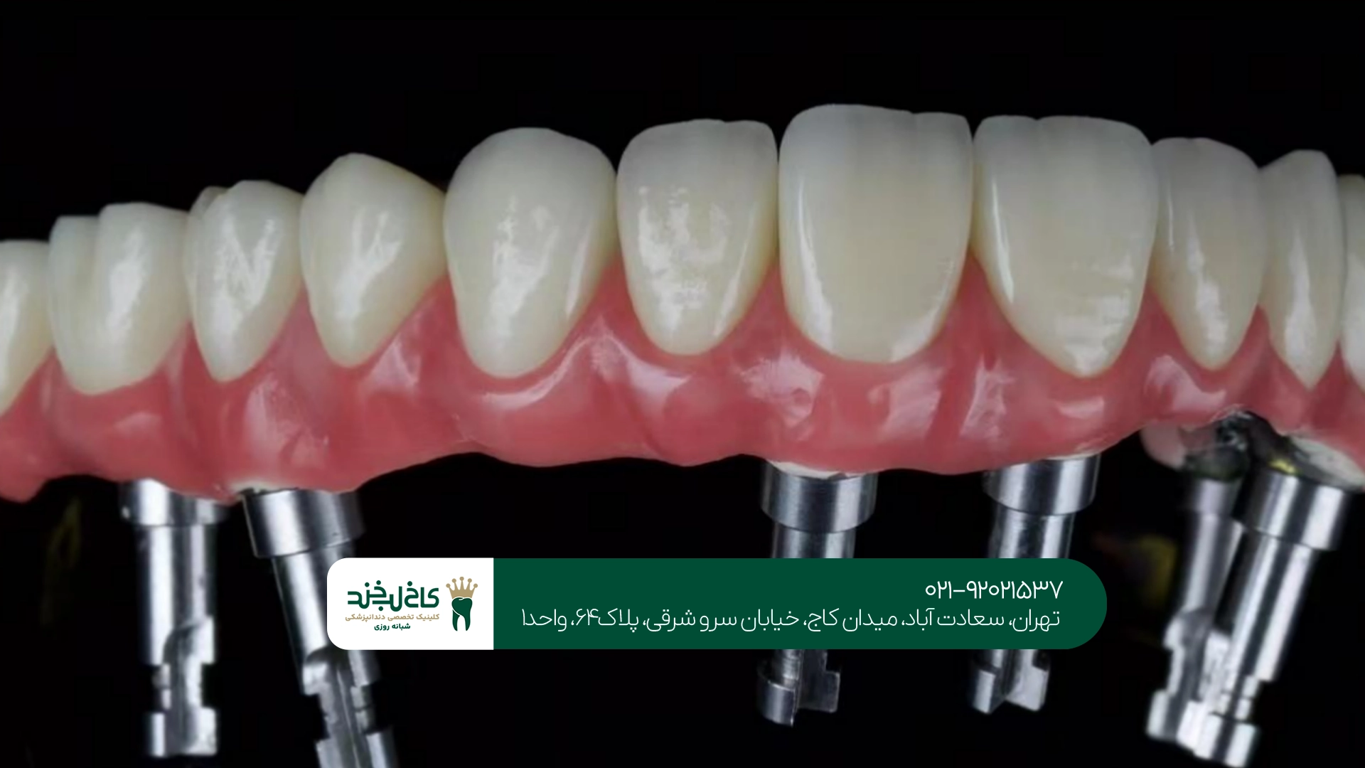 متخصص اوردنچر در تهران متخصص اوردنچر در تهران