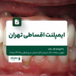 ایمپلنت اقساطی تهران