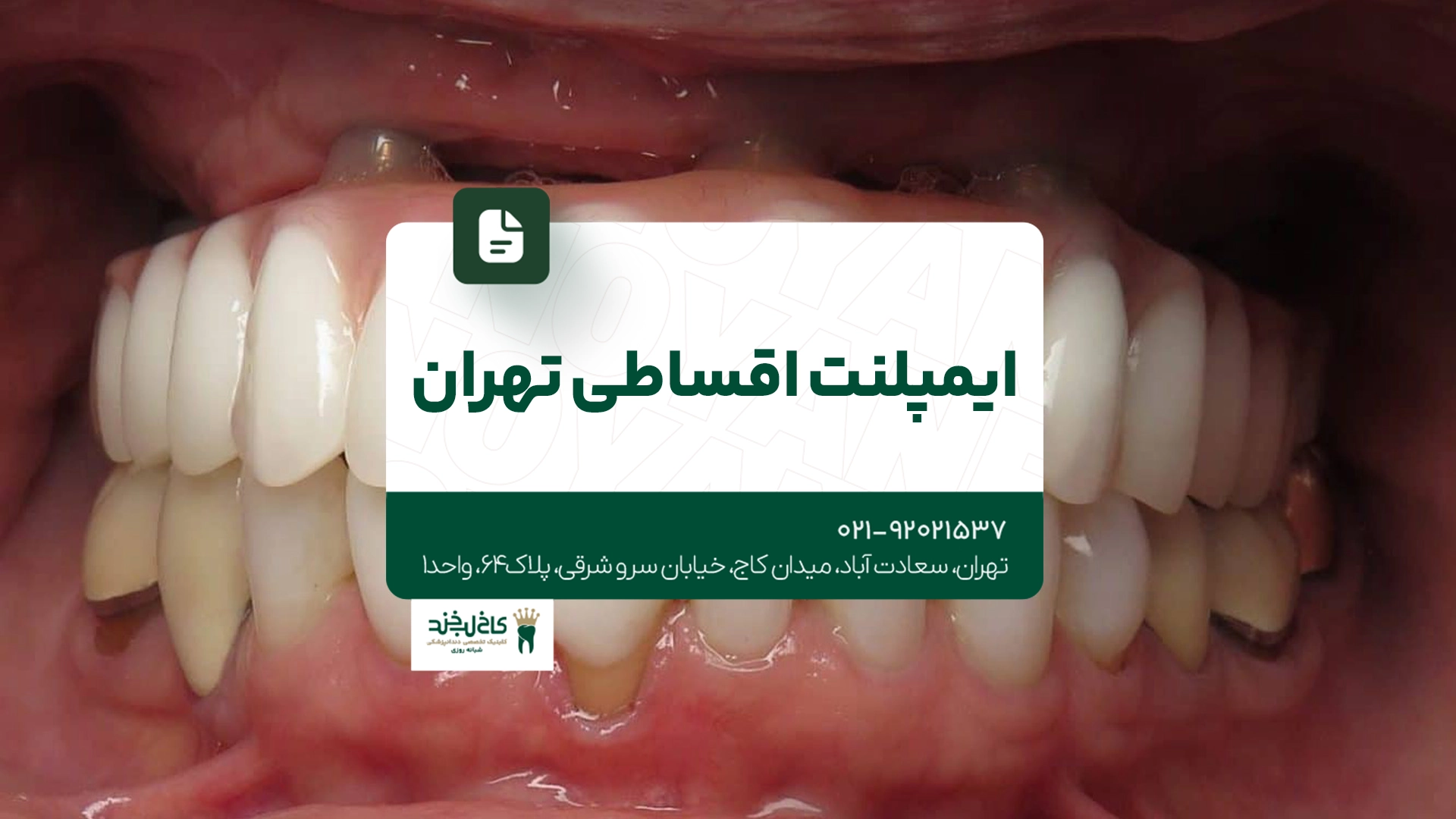 ایمپلنت اقساطی تهران ایمپلنت اقساطی تهران