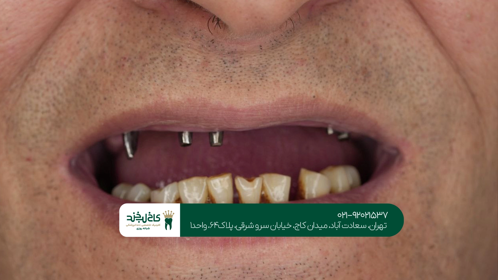 ایمپلنت دندان در تهران ایمپلنت دندان در تهران