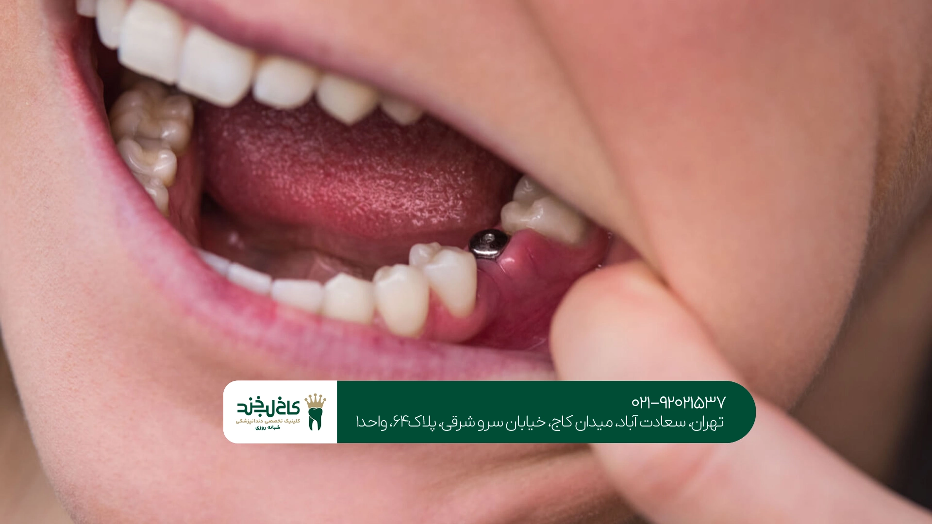 کلینیک ایمپلنت اقساطی تهران کلینیک ایمپلنت اقساطی تهران