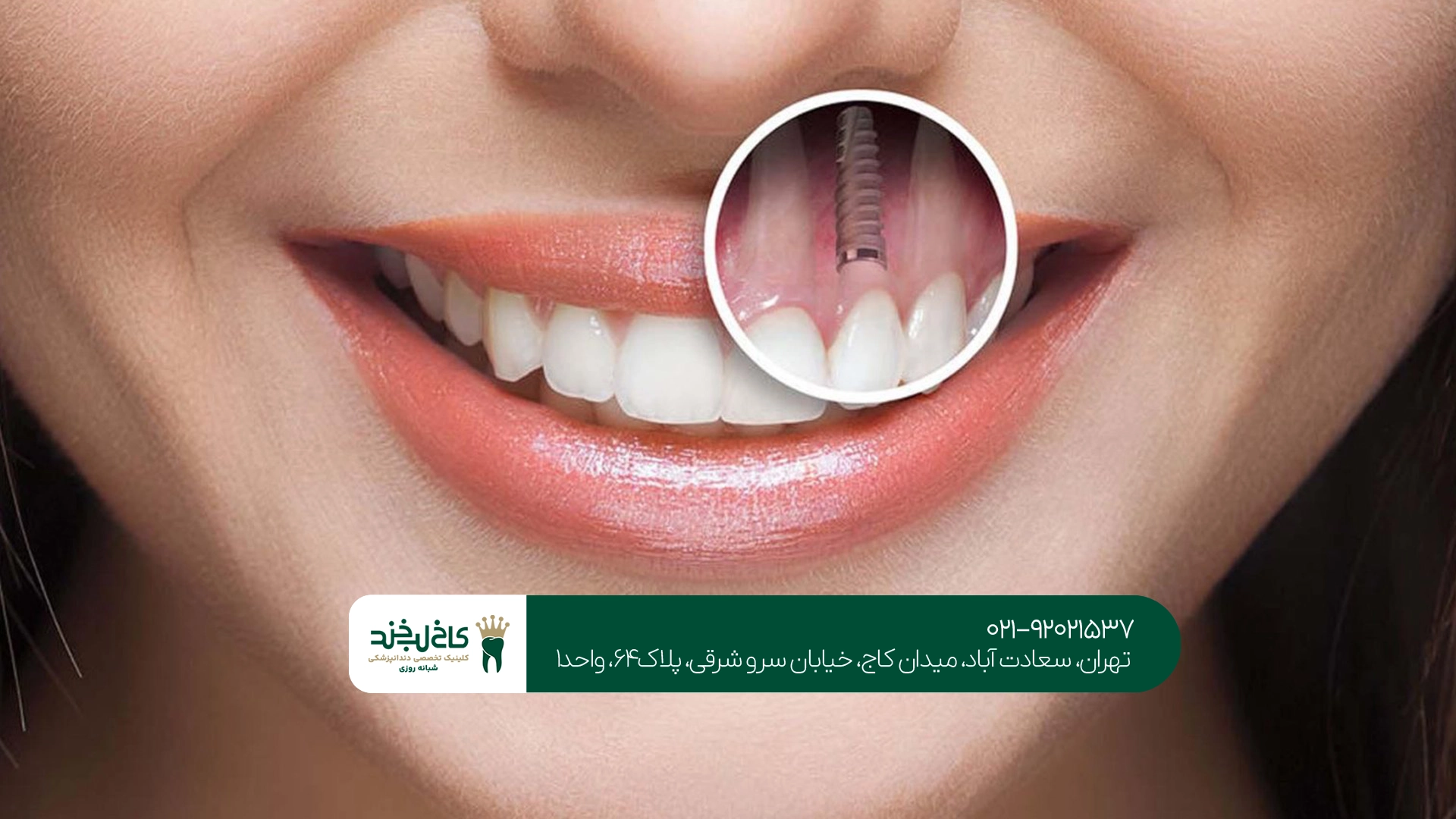 دندانپزشکی ایمپلنت اقساطی تهران دندانپزشکی ایمپلنت اقساطی تهران