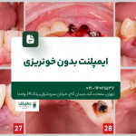 ایمپلنت بدون خونریزی