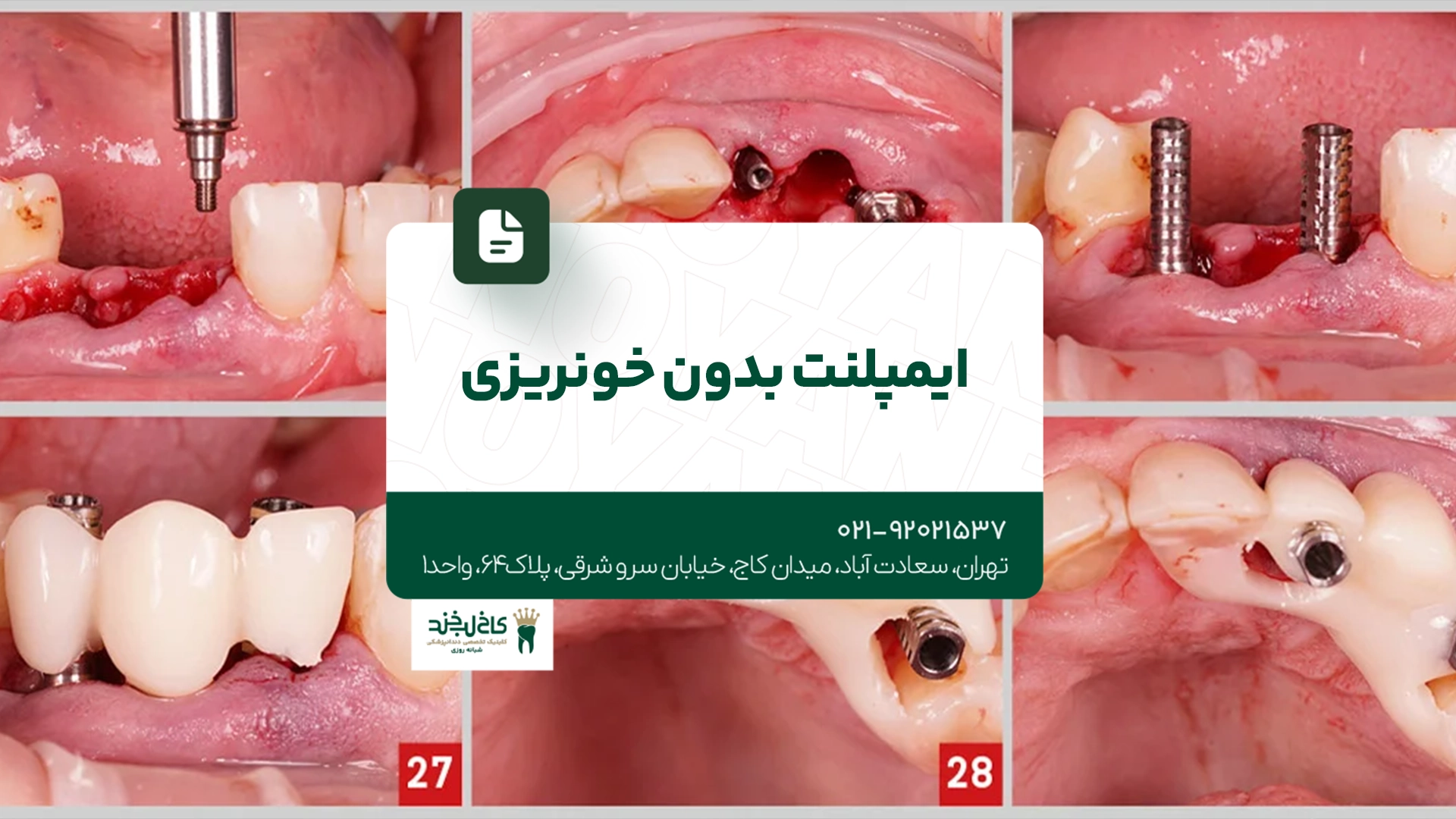 ایمپلنت بدون خونریزی