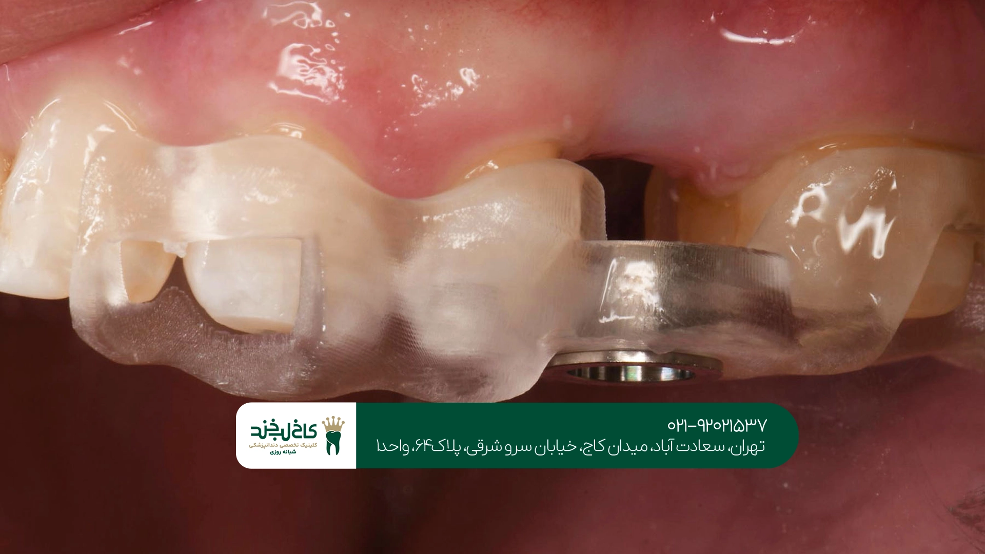 مزایای ایمپلنت بدون خونریزی
