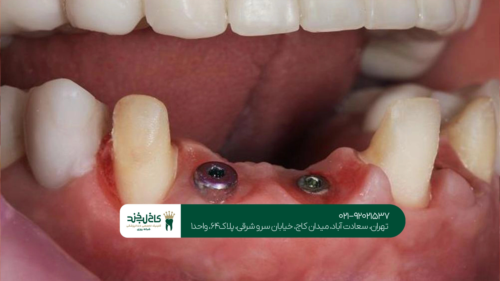بهترین مرکز ایمپلنت بدون خونریزی