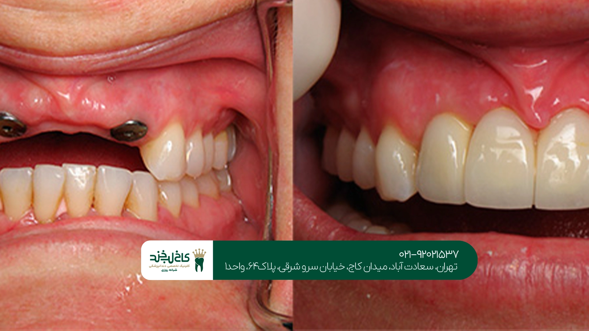 متخصص ایمپلنت بدون خونریزی