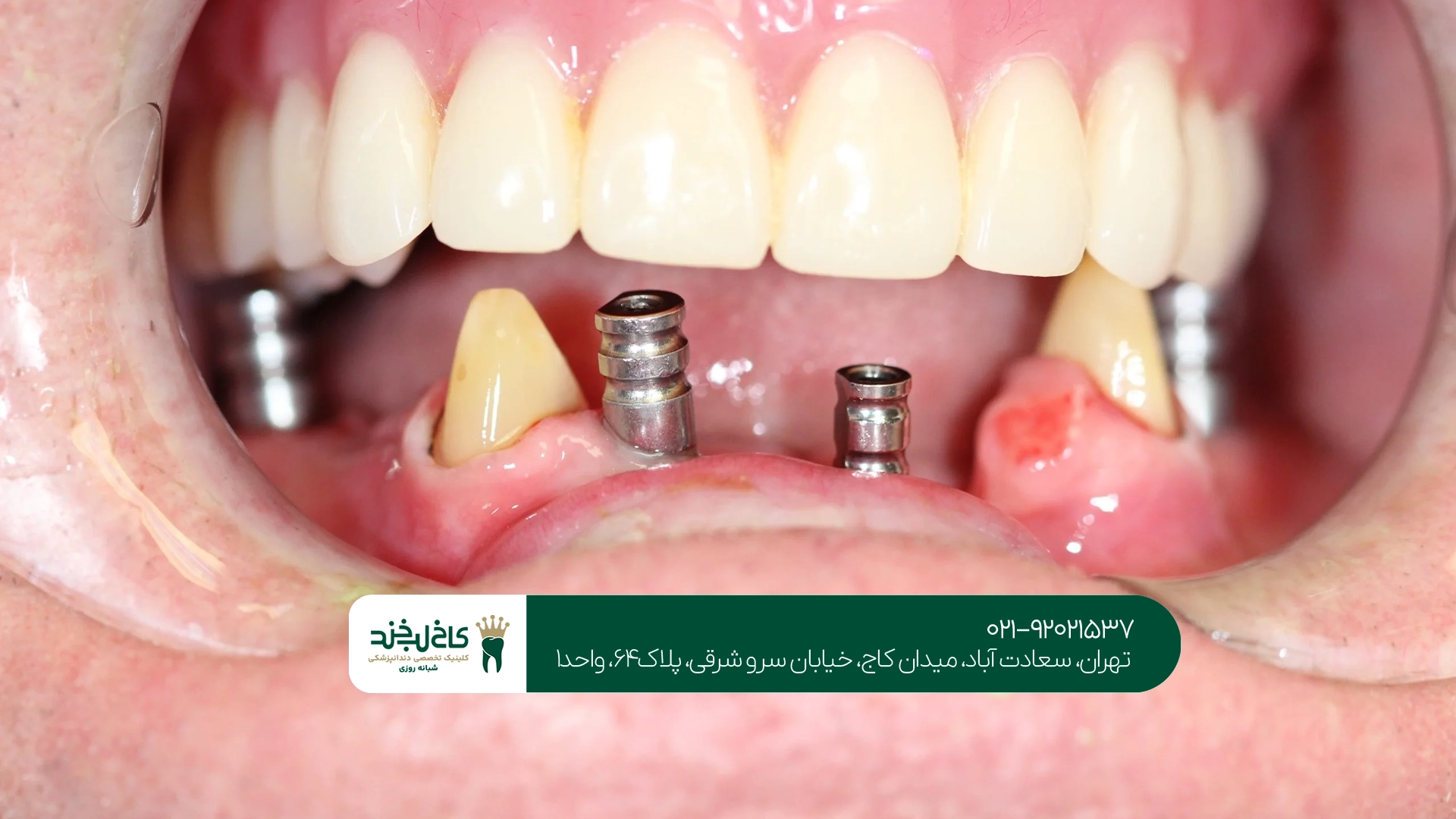 مزایا و معایب ایمپلنت دندان برای بیماران دیابتی