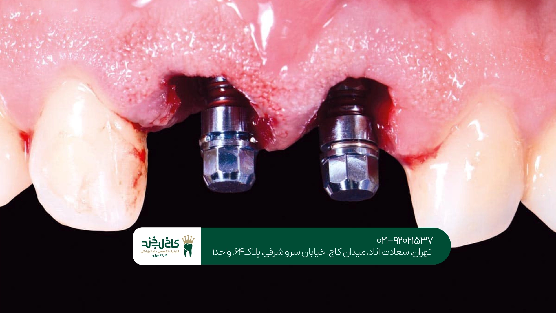 چه زمانی افراد دیابتی نباید ایمپلنت دندان انجام دهند؟