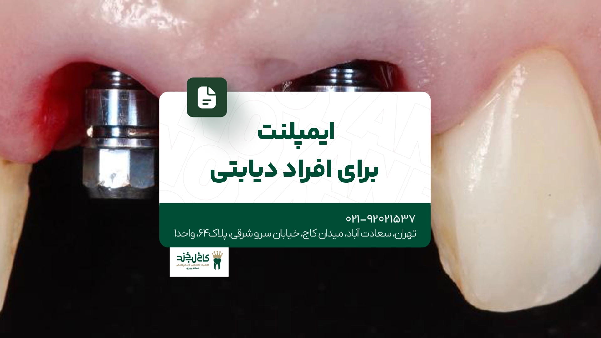 ایمپلنت برای افراد دیابتی