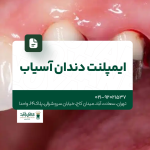 ایمپلنت دندان آسیاب