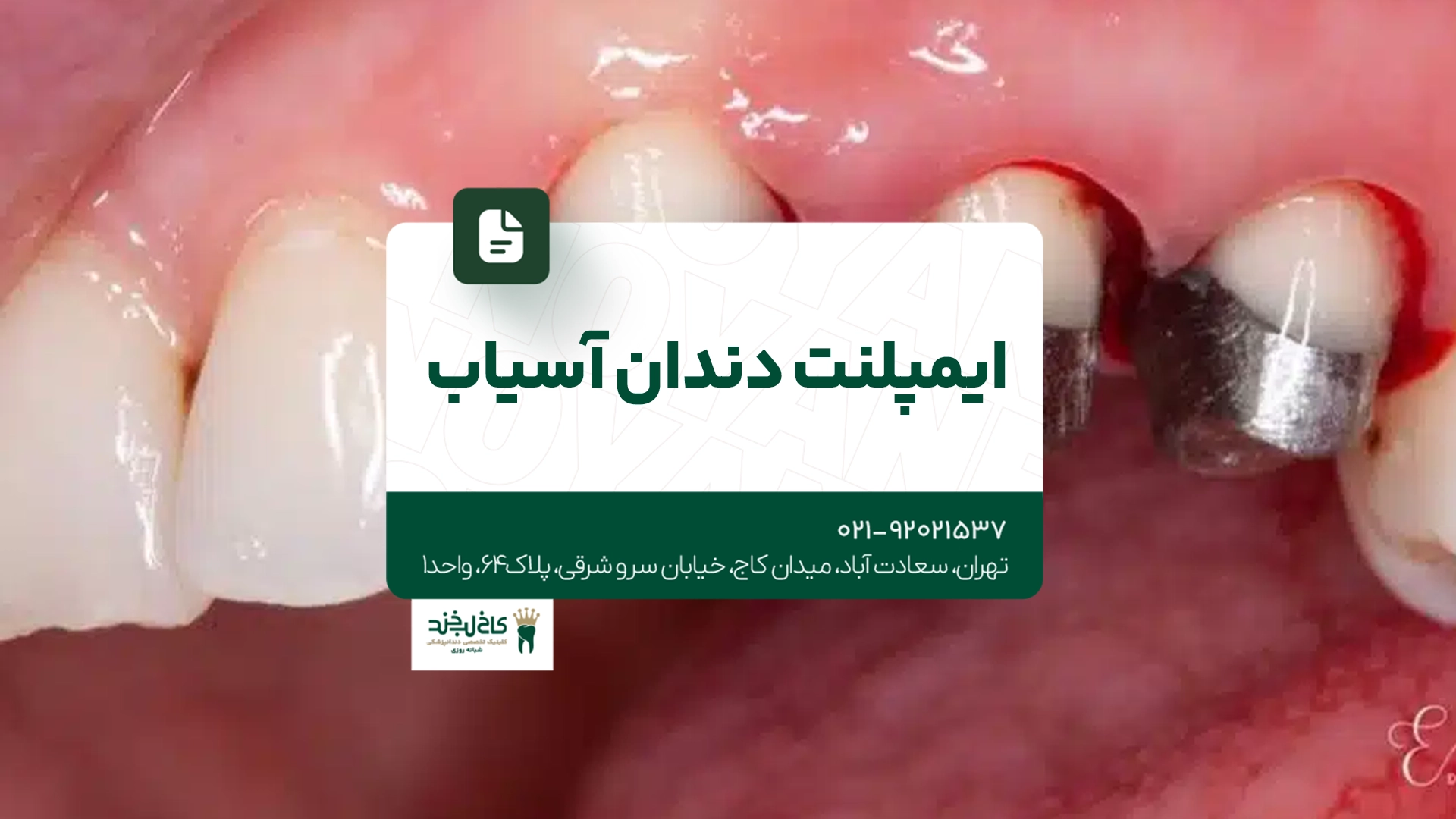 ایمپلنت دندان آسیاب