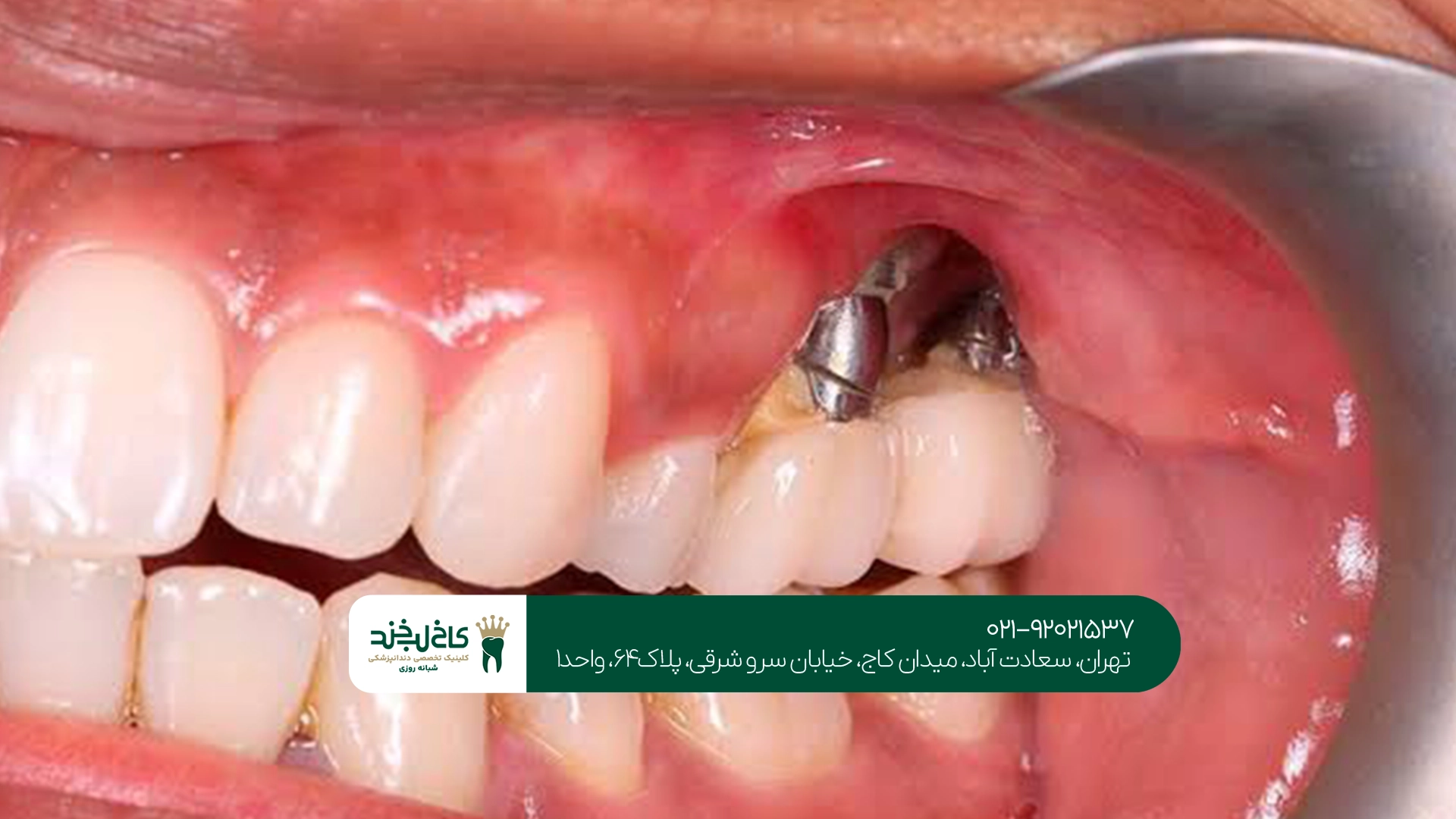 ایمپلنت دندان آسیاب در تهران