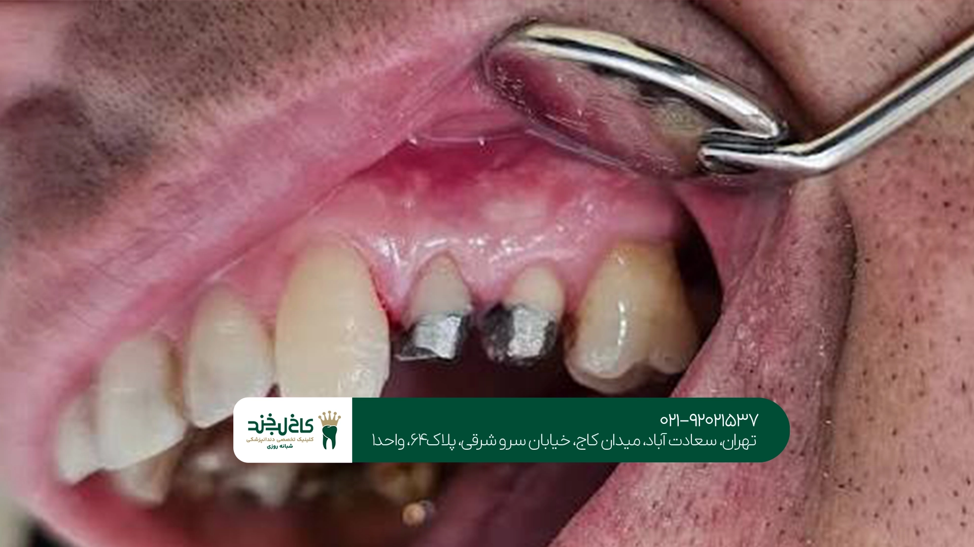 هزینه ایمپلنت دندان آسیاب