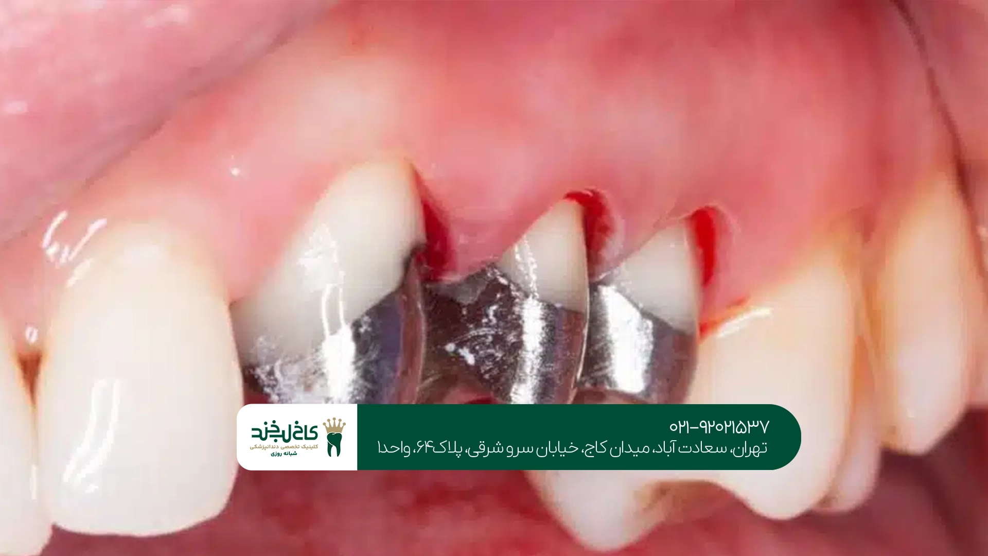 مزایای ایمپلنت دندان آسیاب