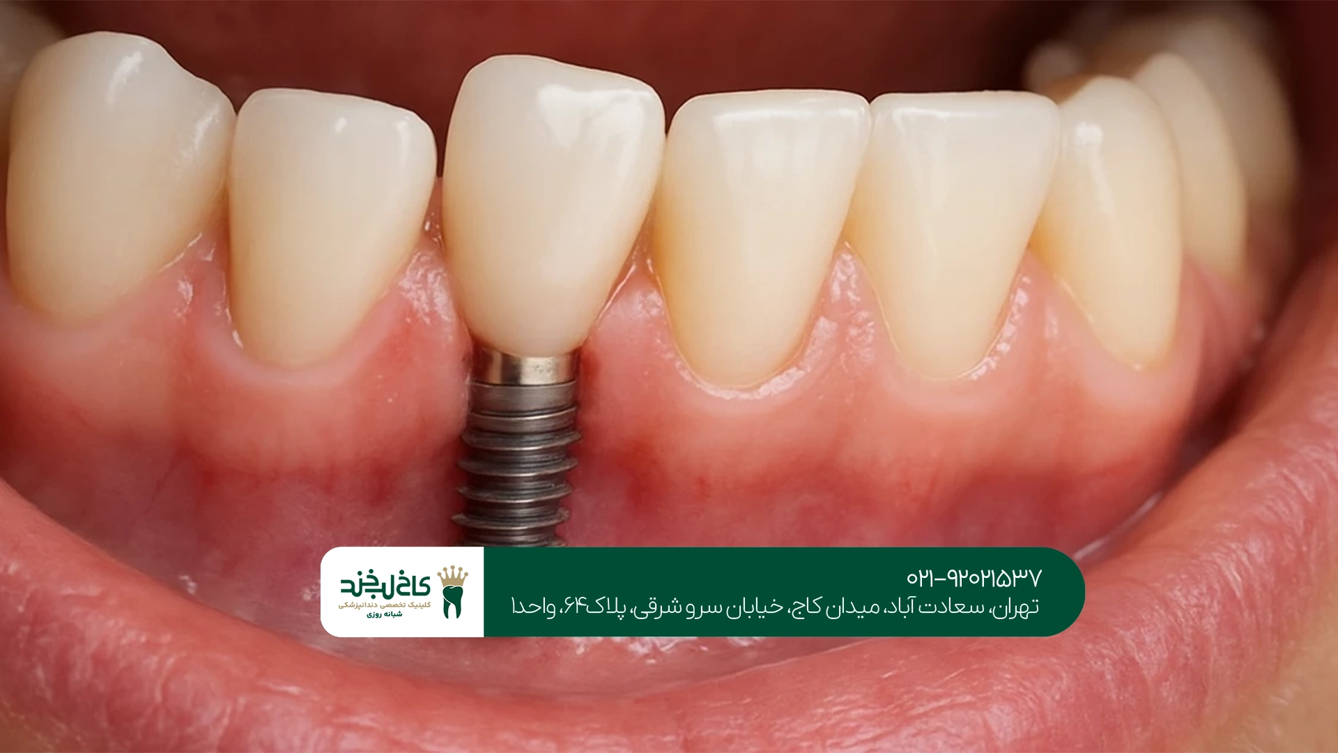 کلینیک تخصصی ایمپلنت با بیهوشی
