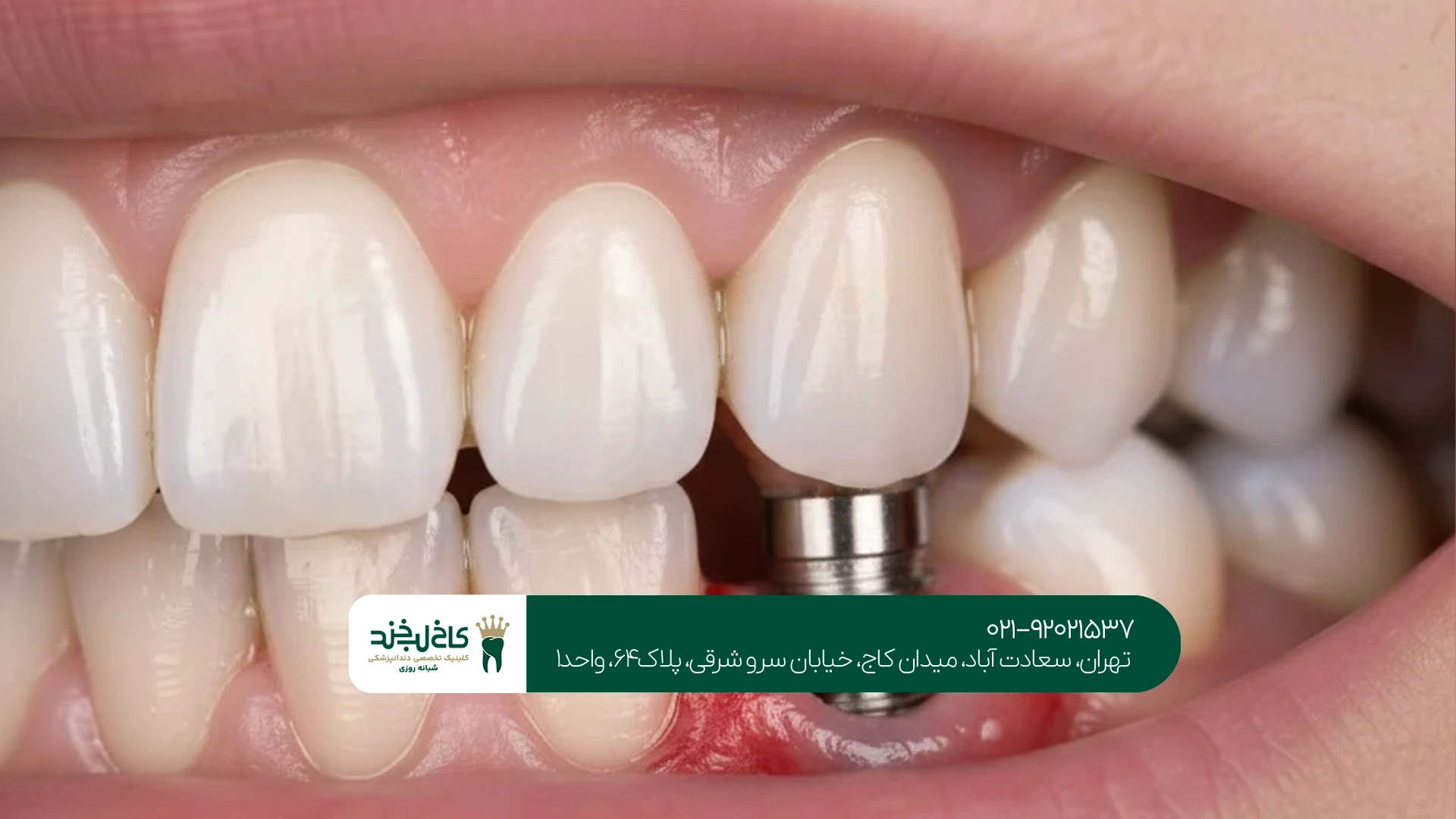 متخصص ایمپلنت دندان با بیهوشی