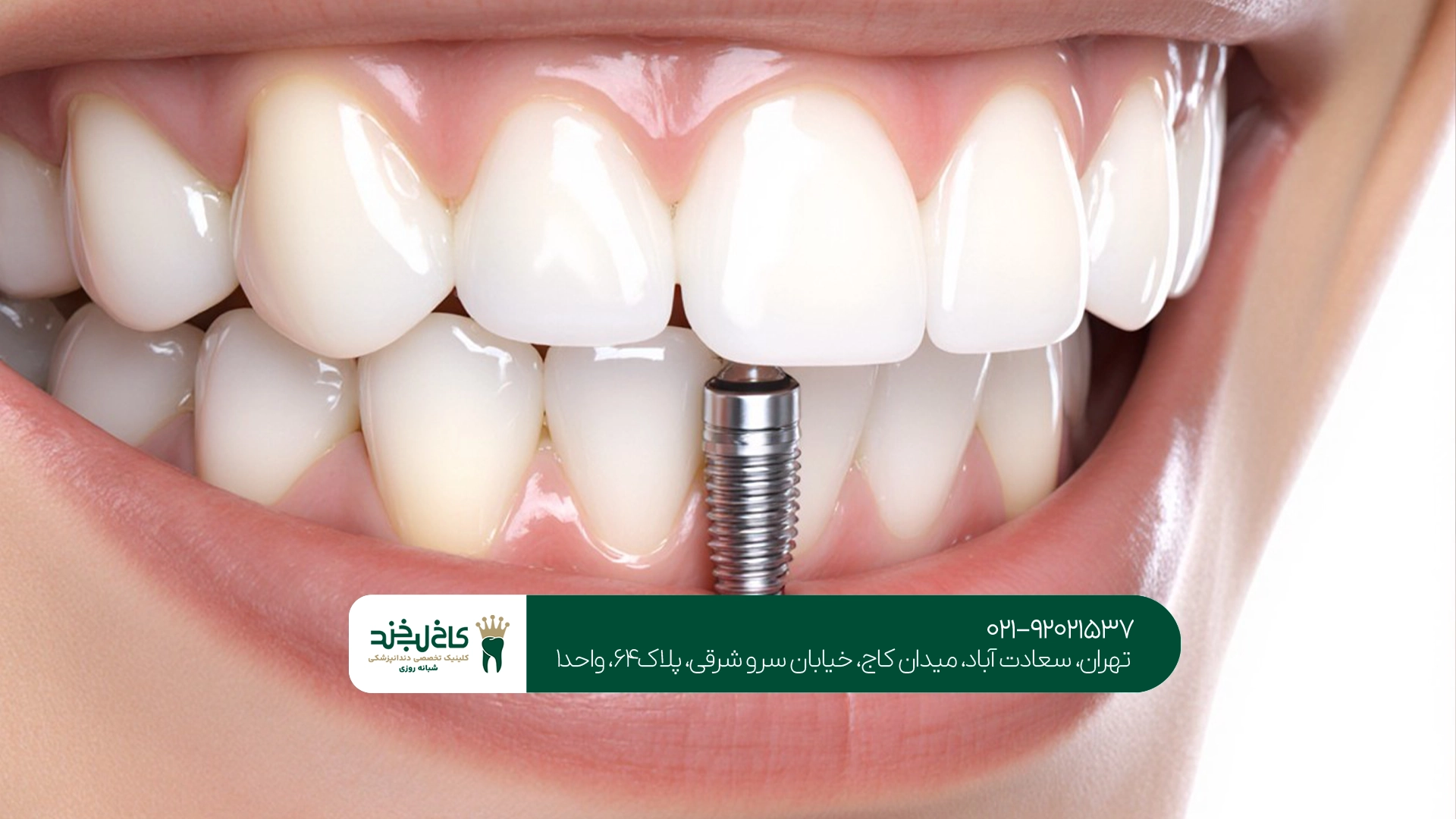 آیا ایمپلنت دندان با بیهوشی ایمن است؟
