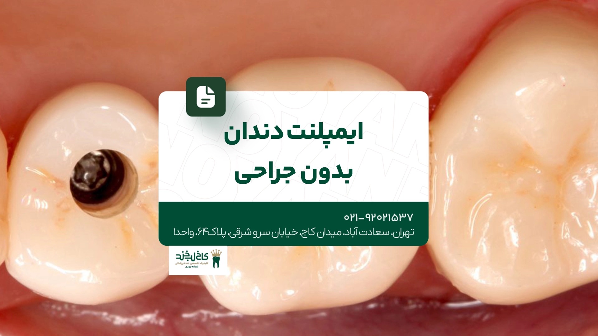ایمپلنت دندان بدون جراحی ایمپلنت دندان بدون جراحی