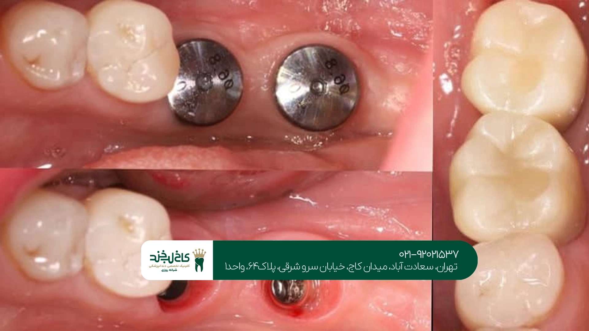 متخصص ایمپلنت دندان بدون جراحی متخصص ایمپلنت دندان بدون جراحی