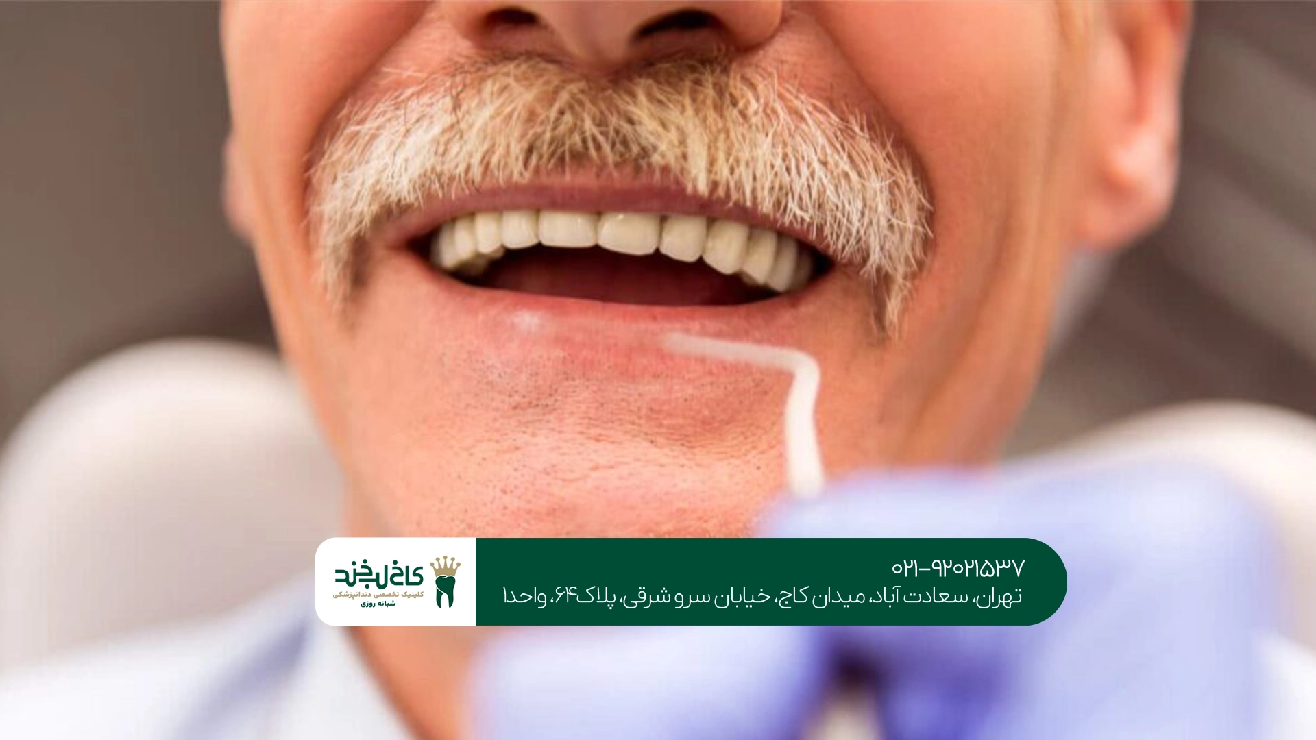 ایمپلنت دندان در تهران ایمپلنت دندان در تهران