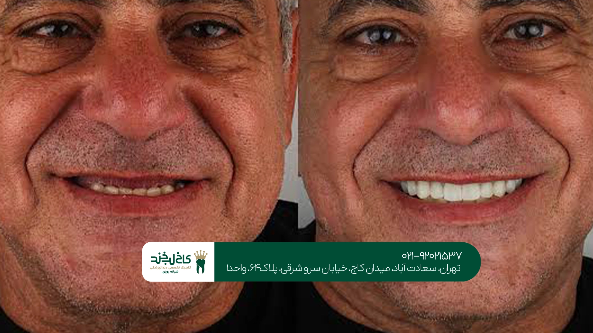 ایمپلنت دندان برای سالمندان در تهران ایمپلنت دندان برای سالمندان در تهران