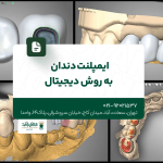 ایمپلنت دندان به روش دیجیتال