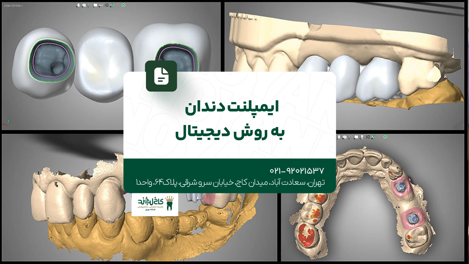 ایمپلنت دندان به روش دیجیتال