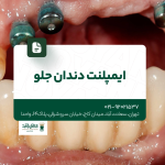 ایمپلنت دندان جلو
