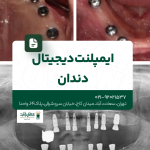 ایمپلنت دیجیتال دندان