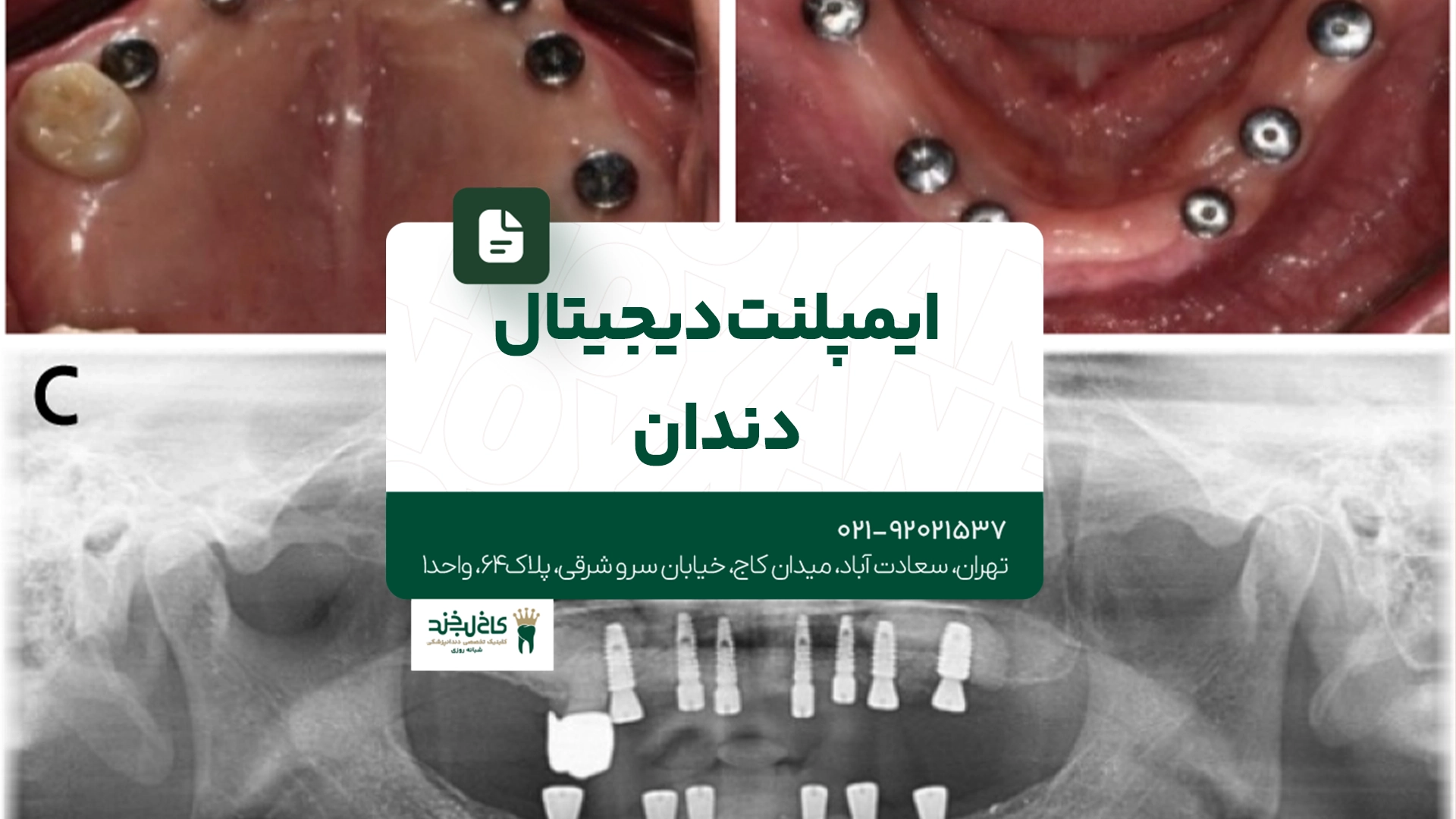 ایمپلنت دیجیتال دندان ایمپلنت دیجیتال دندان