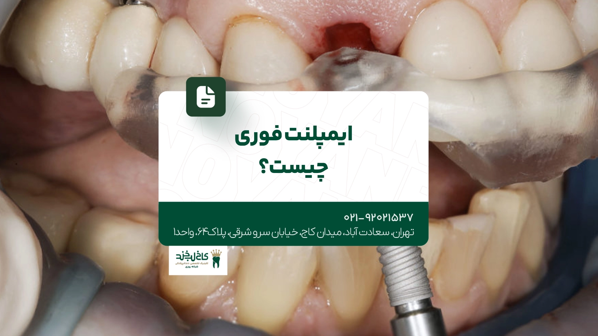 ایمپلنت فوری چیست