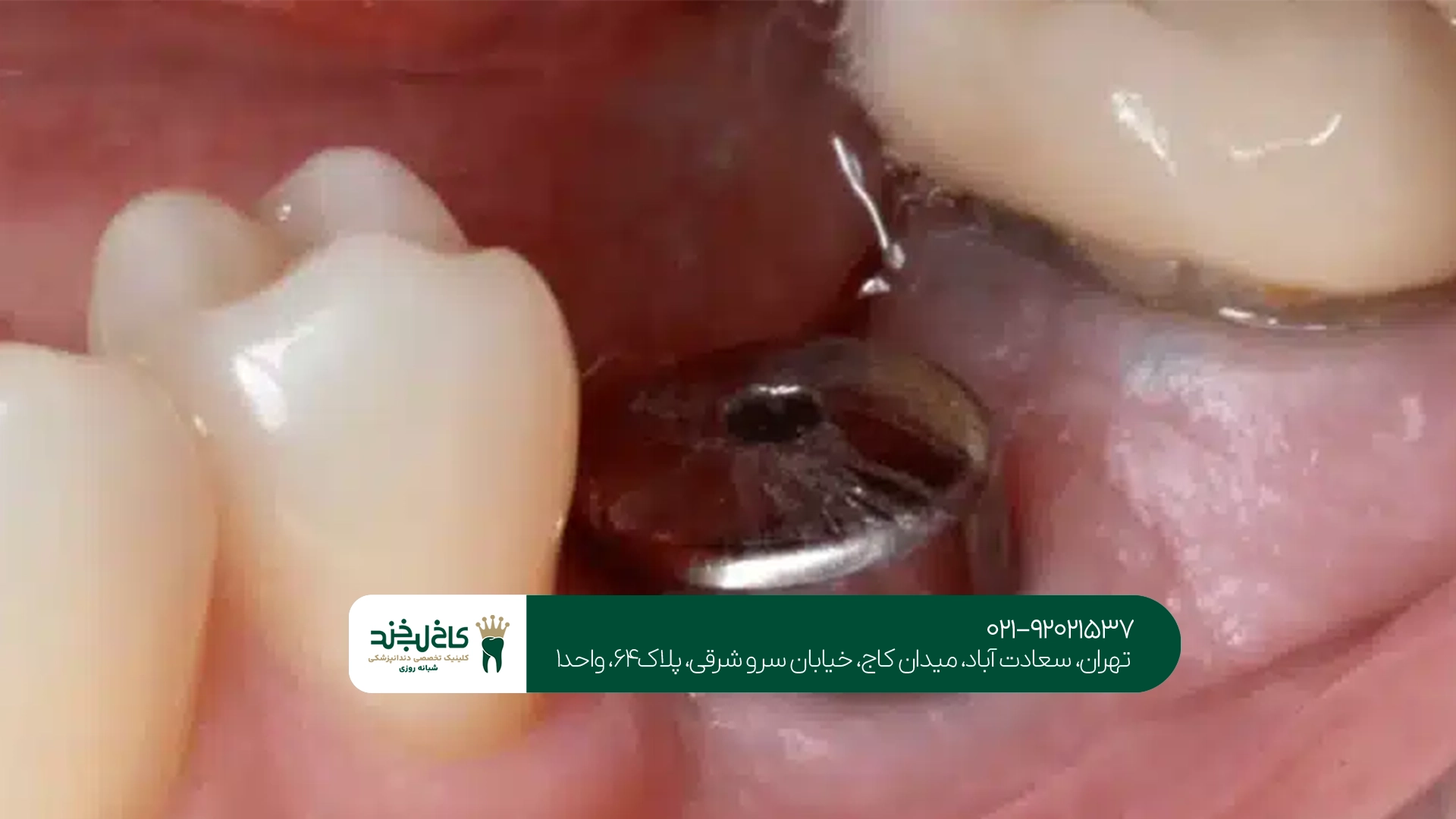 ایمپلنت فوری اقساطی