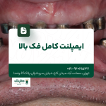 ایمپلنت کامل فک بالا