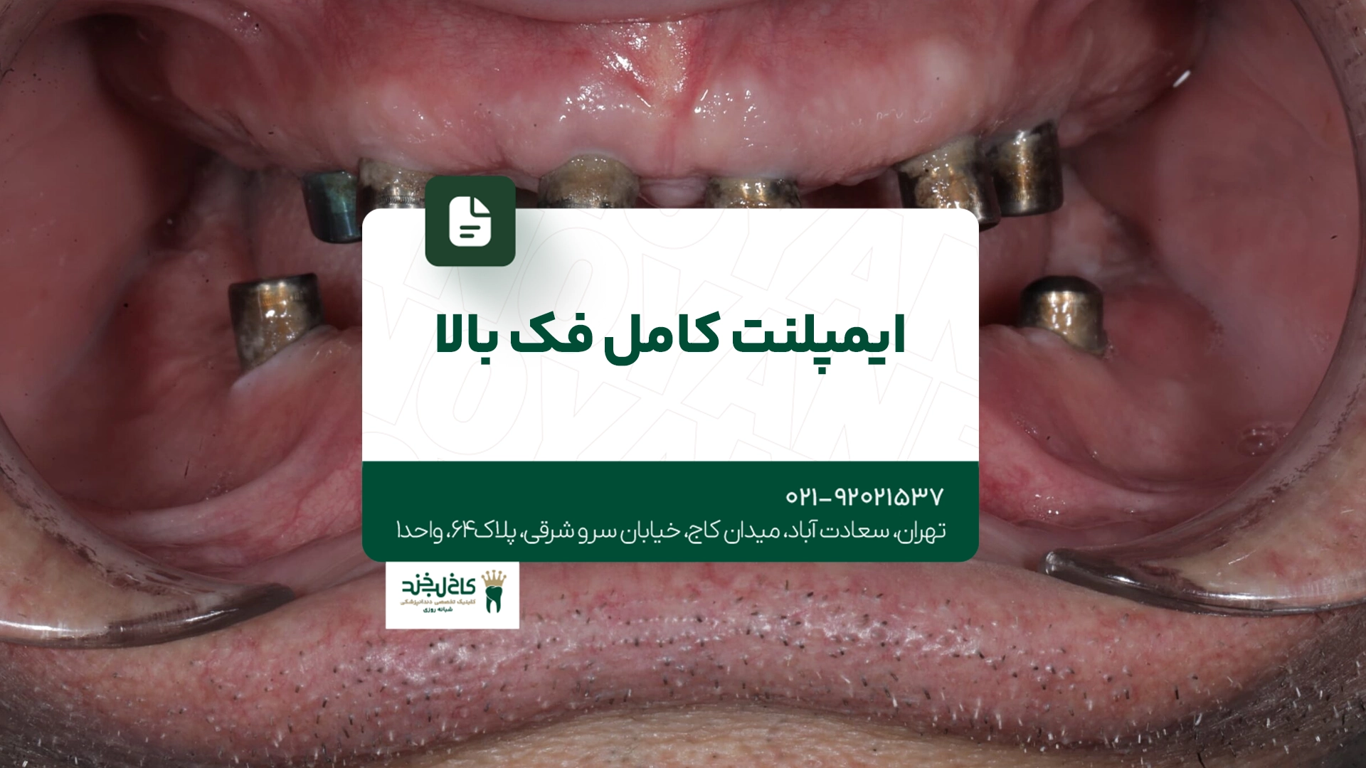 ایمپلنت کامل فک بالا ایمپلنت کامل فک بالا