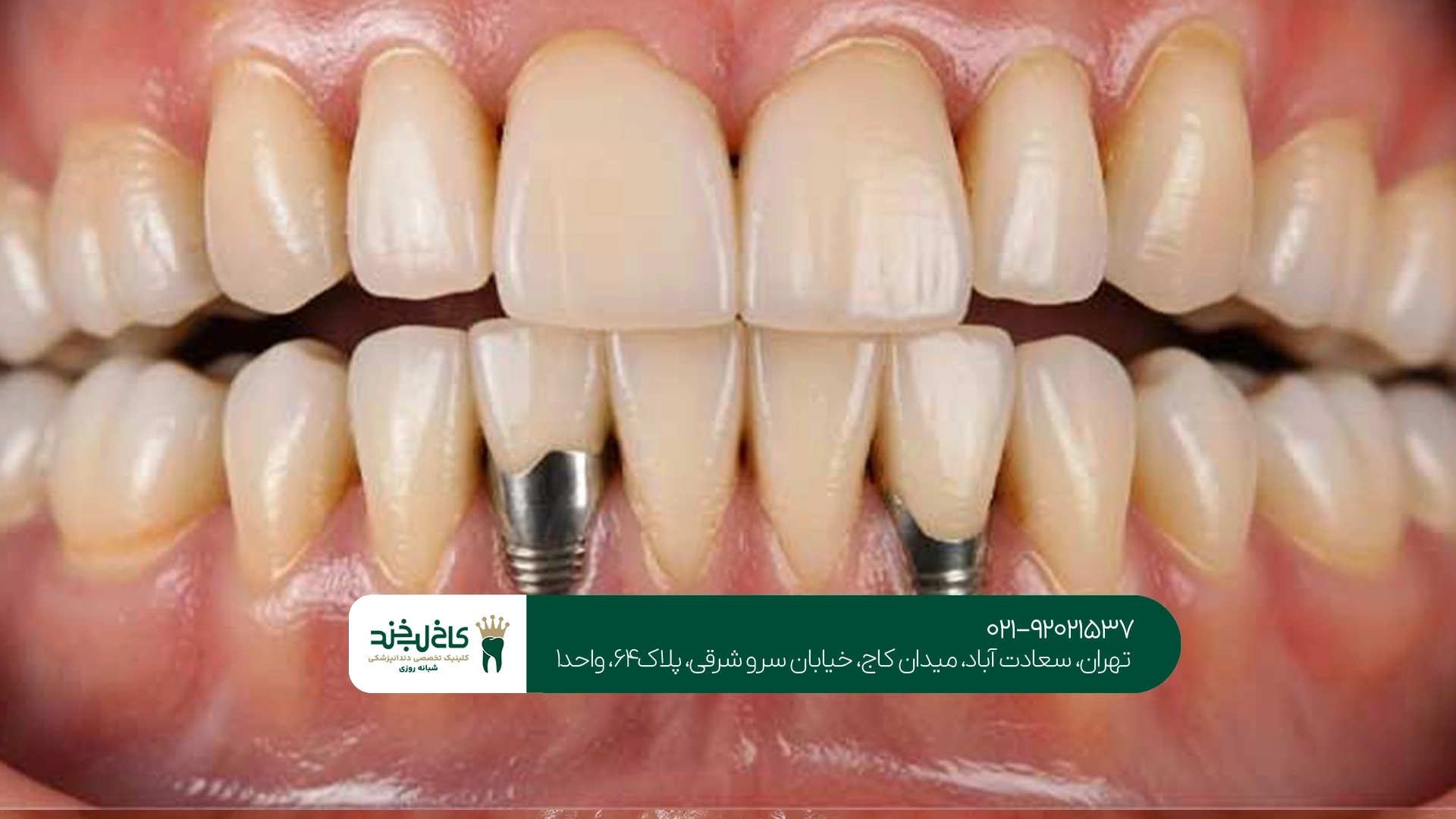 ایمپلنت دندان در تهران ایمپلنت دندان در تهران