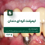 ایمپلنت کرهای دندان