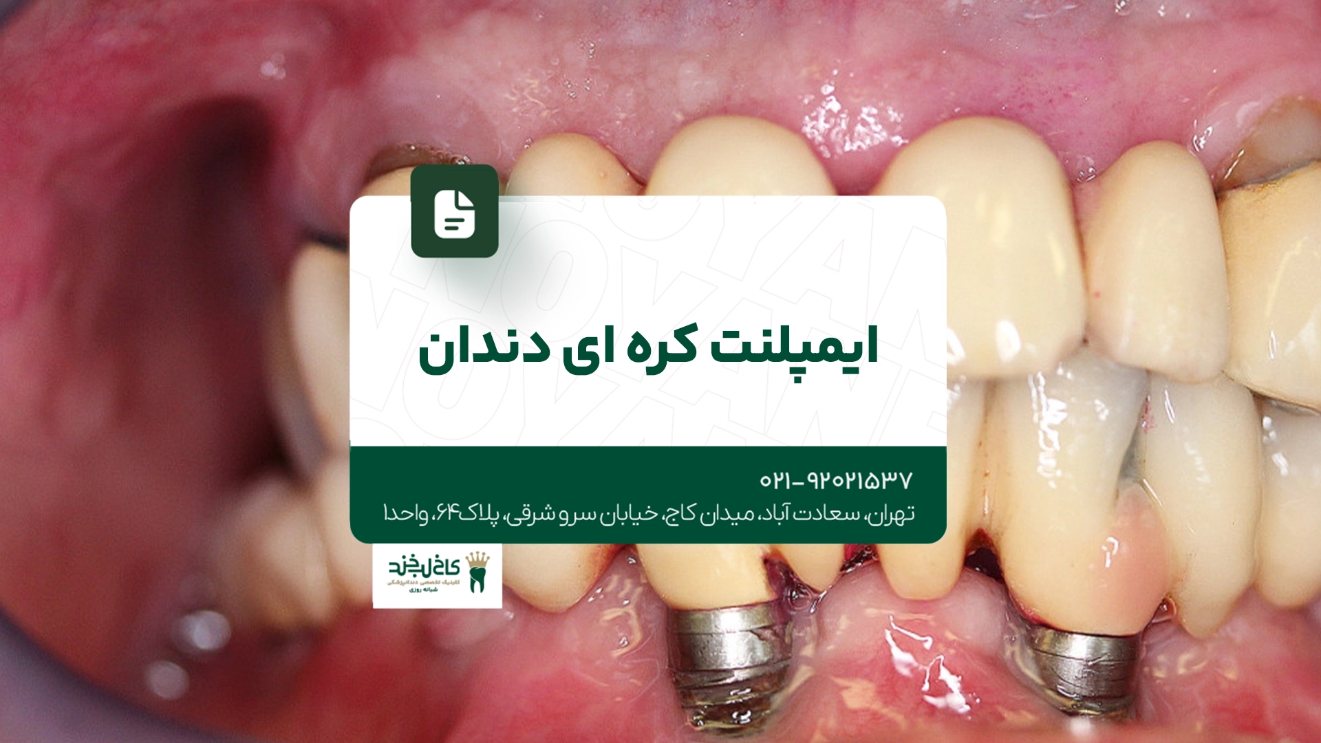ایمپلنت کرهای دندان ایمپلنت کرهای دندان