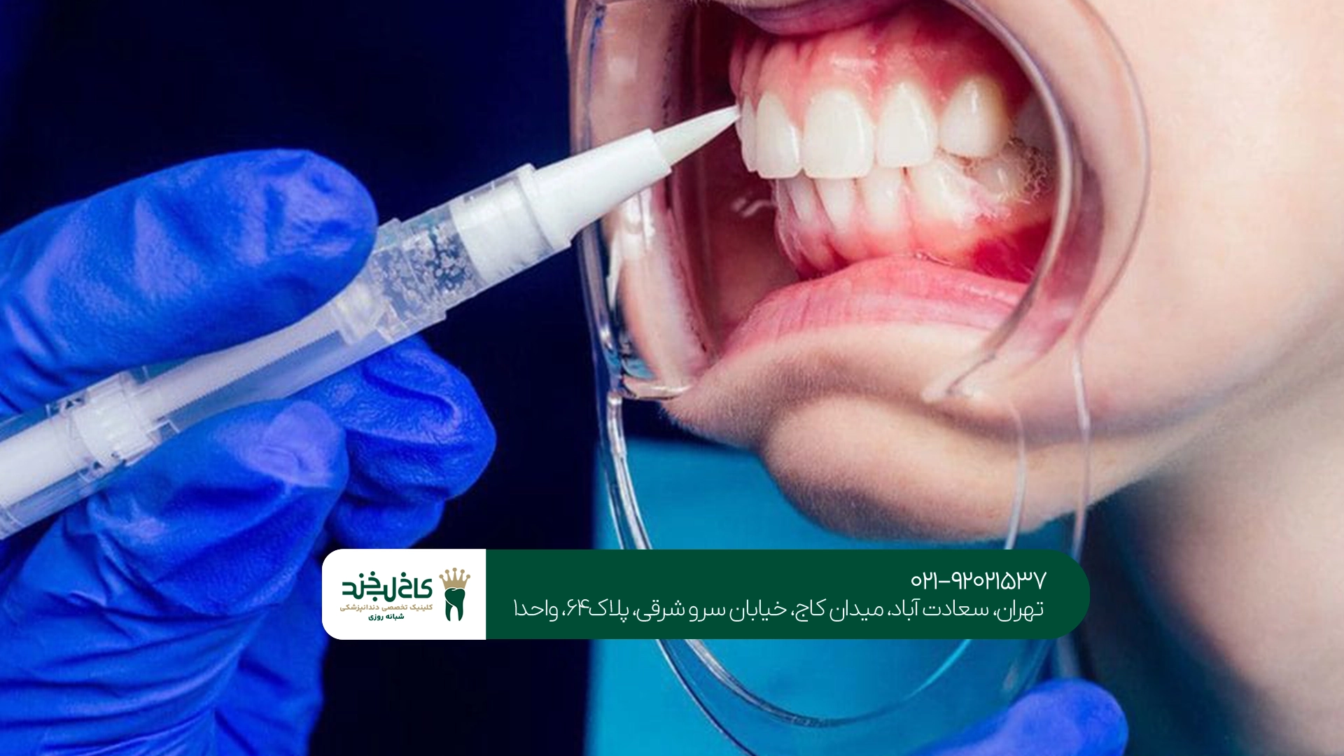 بلیچینگ دندان در تهران بلیچینگ دندان در تهران