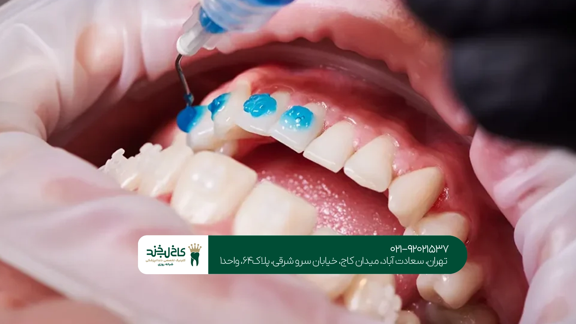 کلینیک بلیچینگ دندان سعادت آباد کلینیک بلیچینگ دندان سعادت آباد