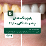 بلیچینگ دندان چقدر ماندگاری دارد