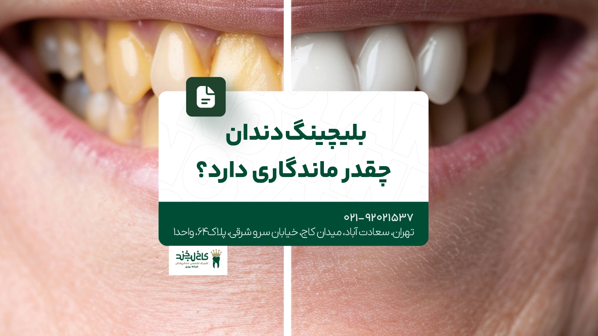 بلیچینگ دندان چقدر ماندگاری دارد
