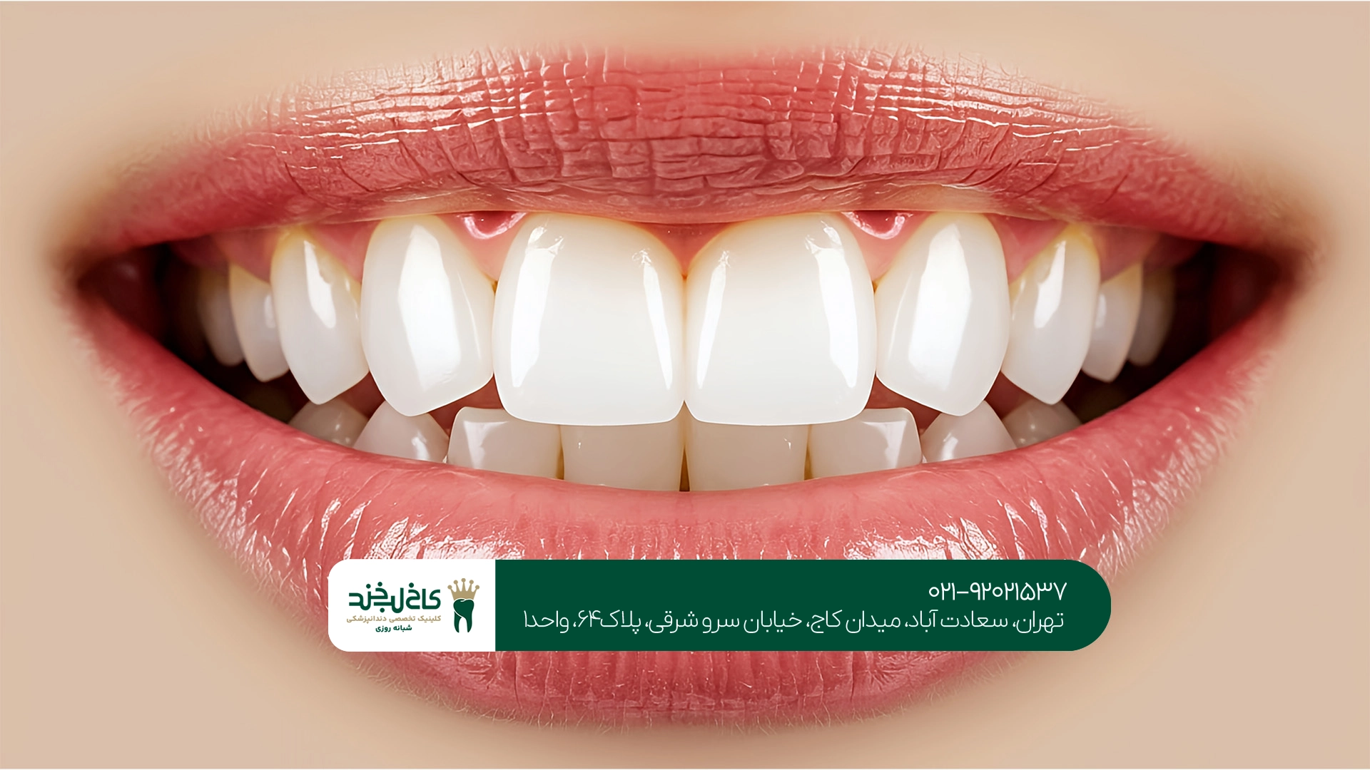 بلیچینگ دندان در تهران بلیچینگ دندان در تهران