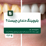 بلیچینگ دندان چیست
