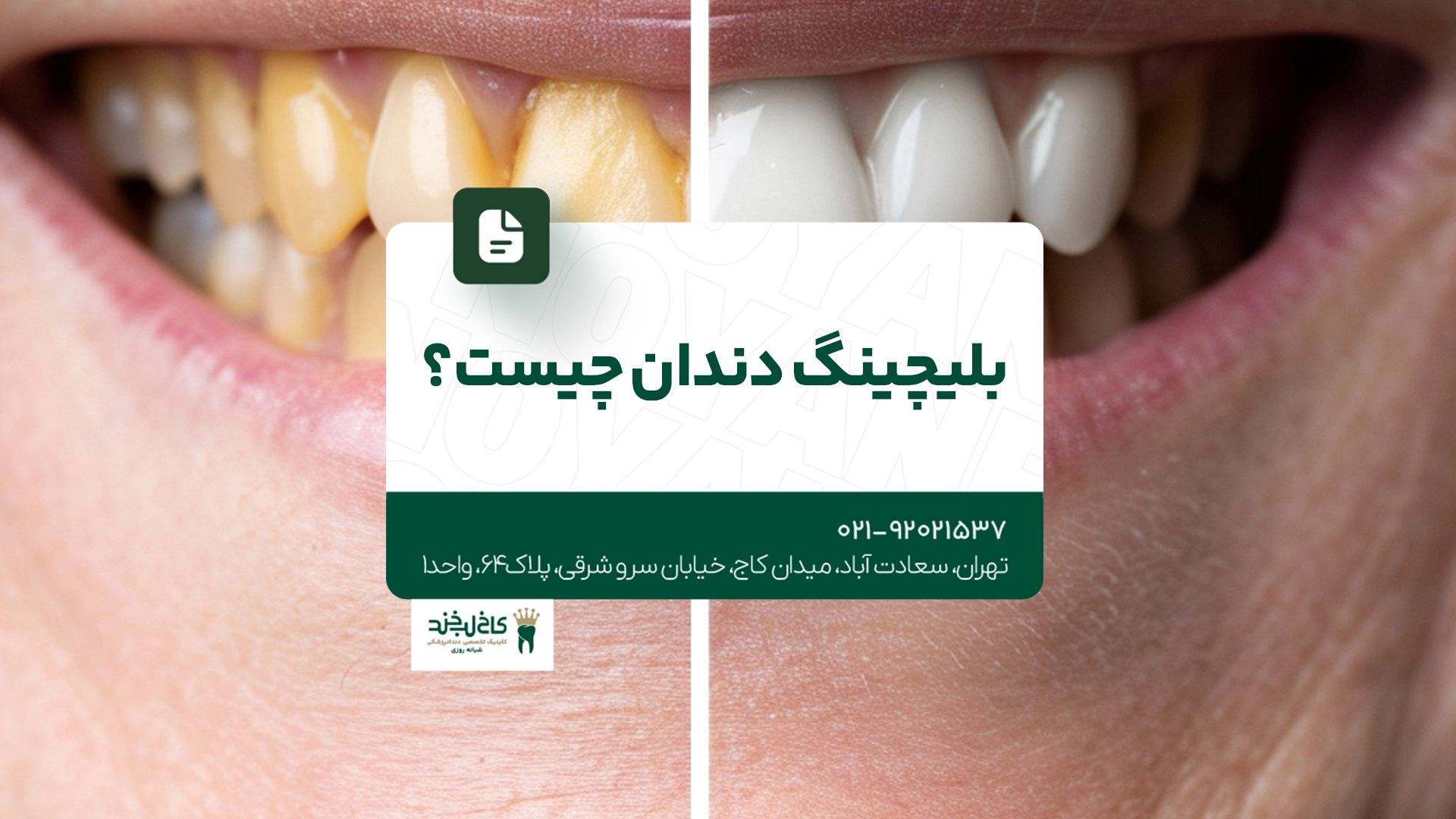 بلیچینگ دندان چیست بلیچینگ دندان چیست